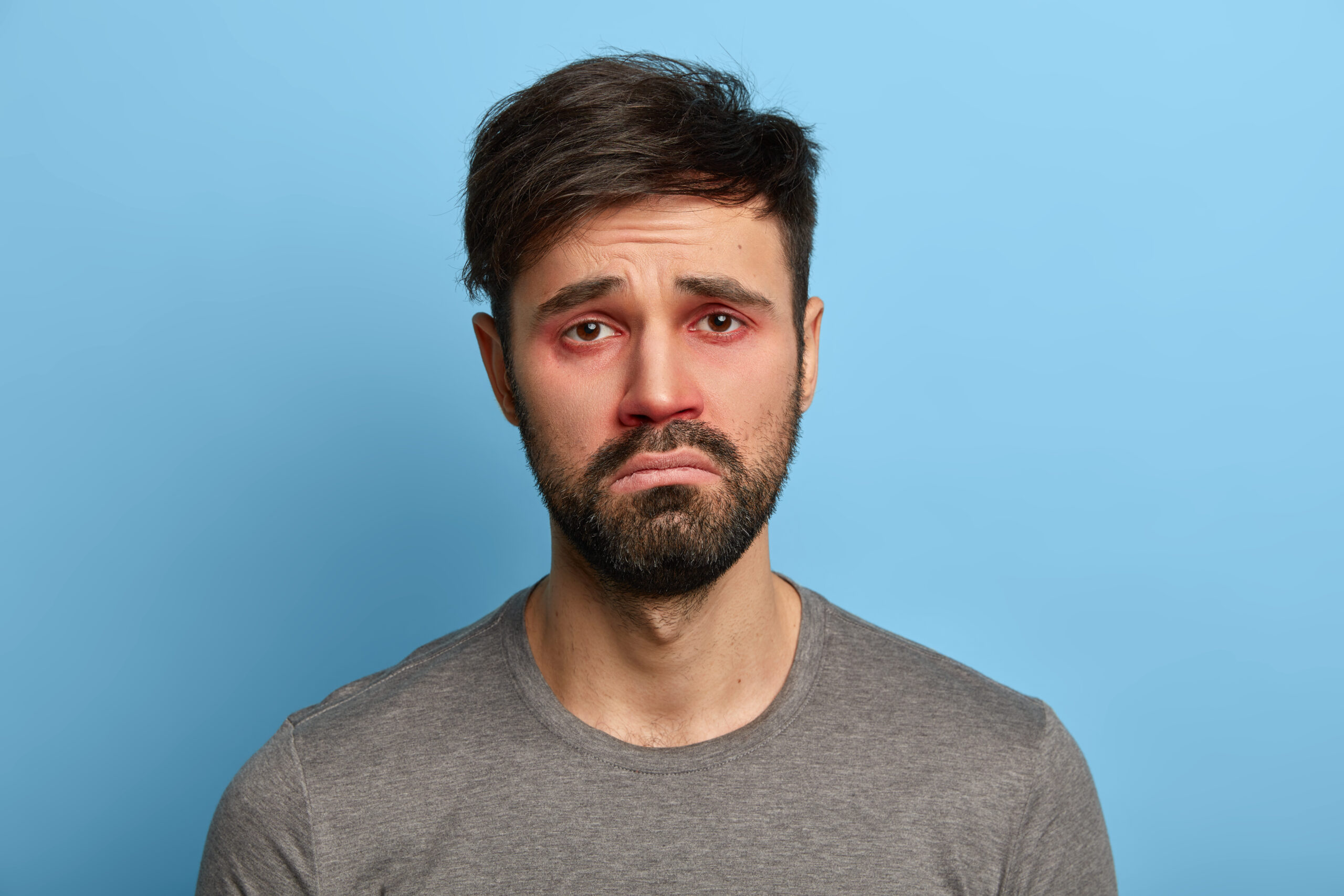 Miserable displeased man has sick look, red swollen eyes, smirks face, suffers from conjunctivitis, seasonal allergy, poses against blue background. People, disease, health problems concept. | Lo Scopribenessere