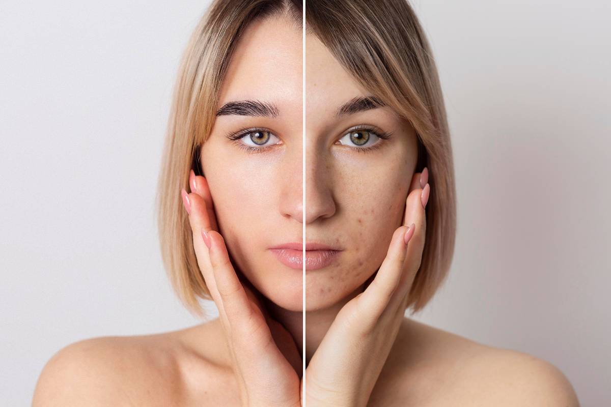 Donna come curare l'acne prima e dopo